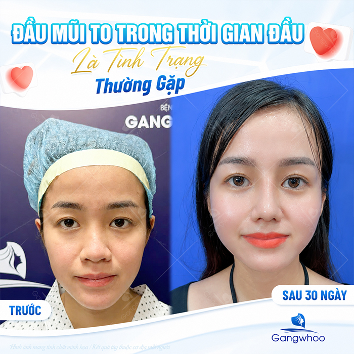 Nâng Mũi Bao Lâu Thì Đầu Mũi Hết To? Bác Sĩ Giải Đáp Chi Tiết