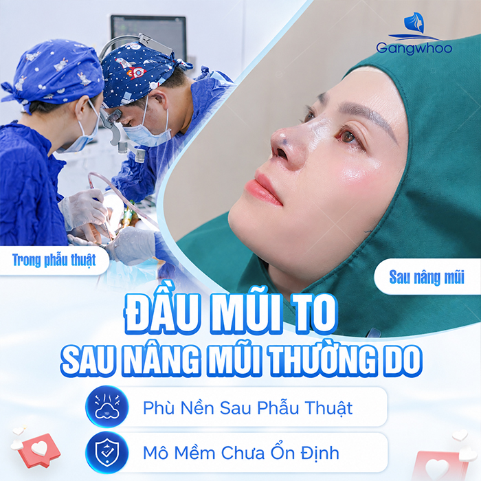 Nâng Mũi Bao Lâu Thì Đầu Mũi Hết To? Bác Sĩ Giải Đáp Chi Tiết