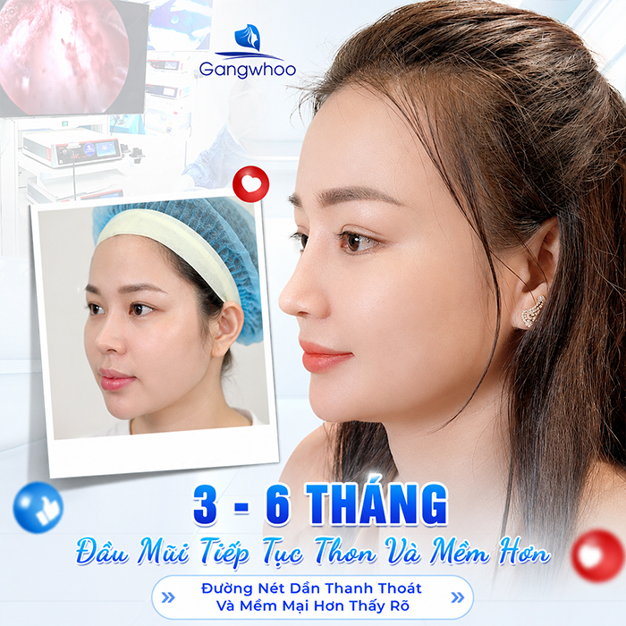 Nâng Mũi Bao Lâu Thì Đầu Mũi Hết To? Bác Sĩ Giải Đáp Chi Tiết