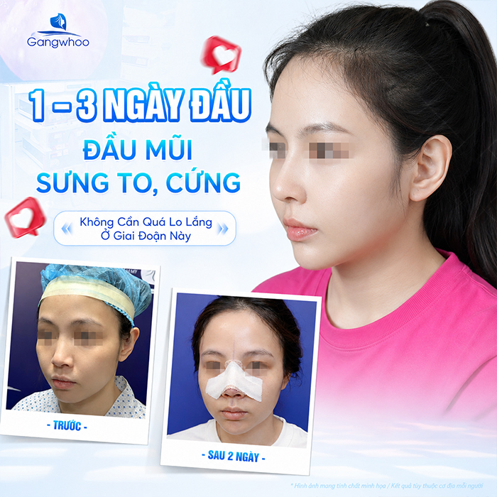 Nâng Mũi Bao Lâu Thì Đầu Mũi Hết To? Bác Sĩ Giải Đáp Chi Tiết