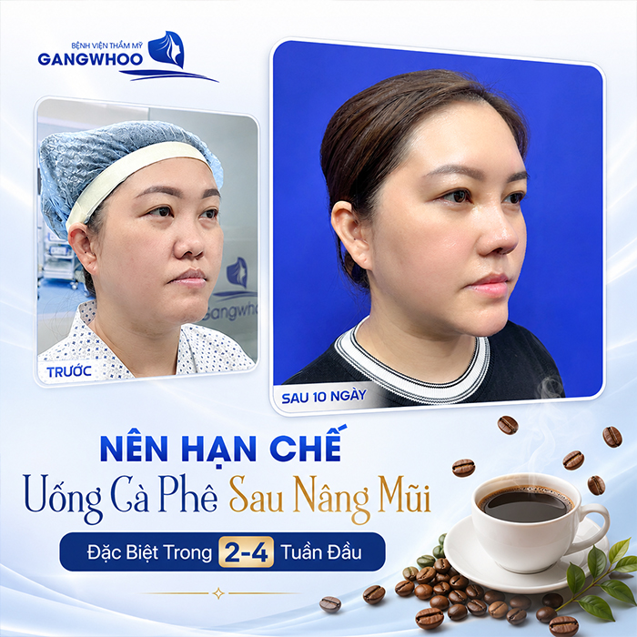 Nâng Mũi Uống Cà Phê Được Không? Bác Sĩ Giải Đáp Chi Tiết Từ Góc Độ Chuyên Môn