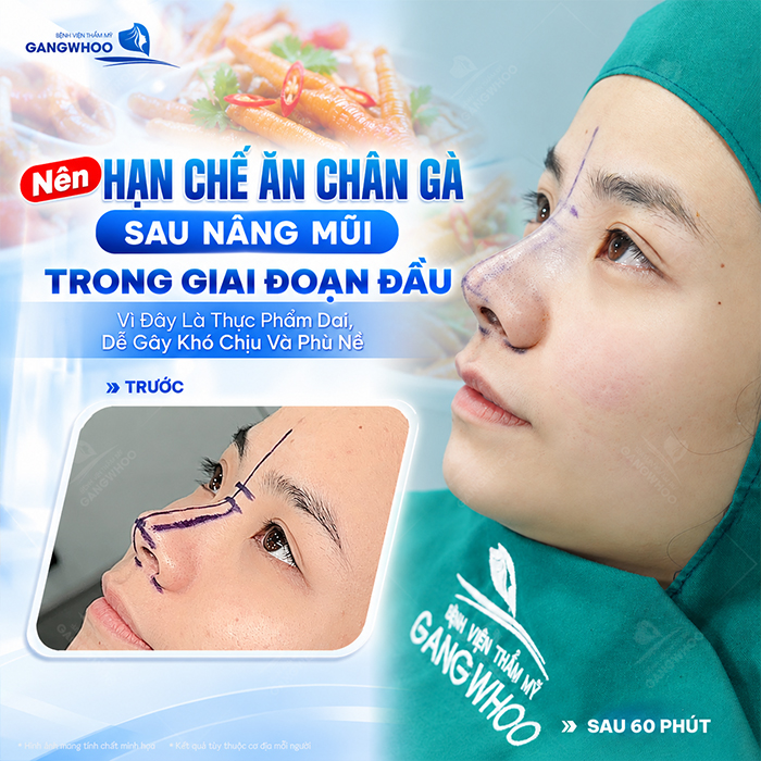 Nâng Mũi Ăn Chân Gà Được Không? Bác Sĩ Giải Đáp