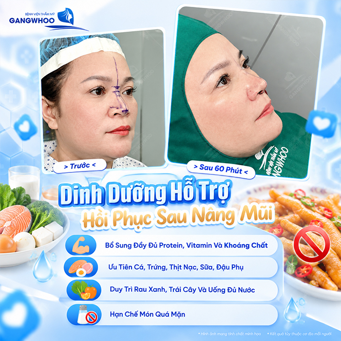 Nâng Mũi Ăn Chân Gà Được Không? Bác Sĩ Giải Đáp