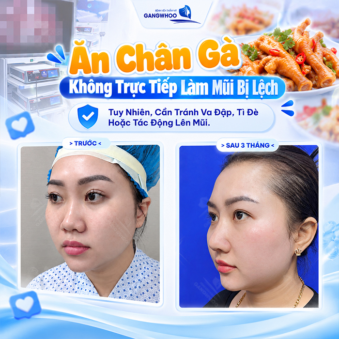 Nâng Mũi Ăn Chân Gà Được Không? Bác Sĩ Giải Đáp