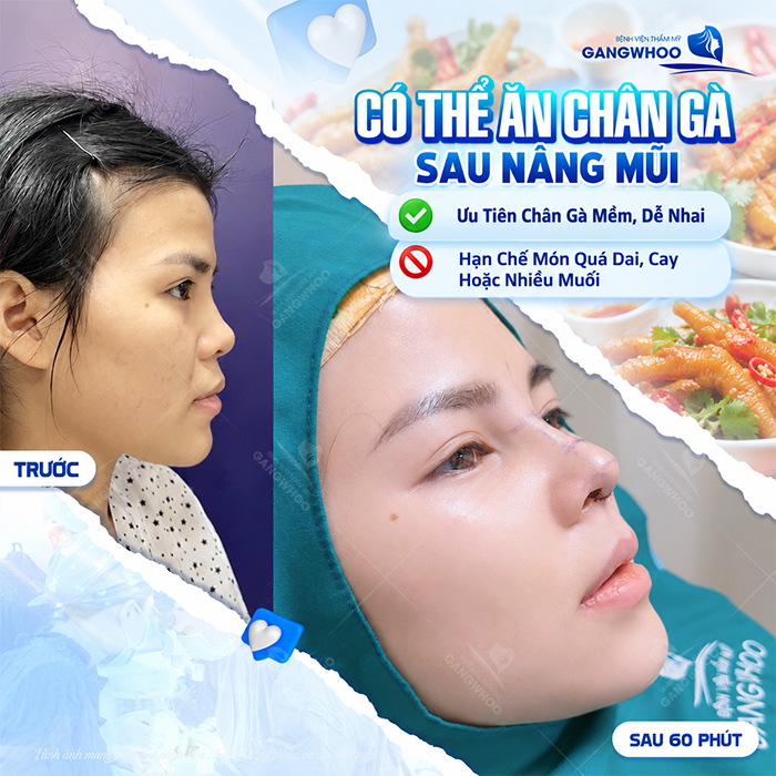 Nâng Mũi Ăn Chân Gà Được Không? Bác Sĩ Giải Đáp