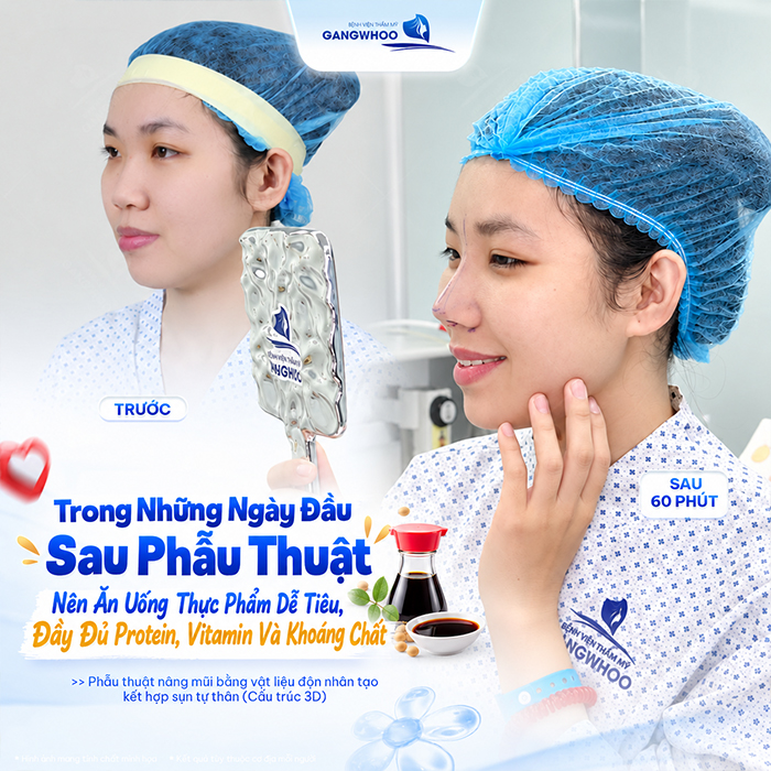 Nâng Mũi Bao Lâu Được Ăn Xì Dầu? Bác Sĩ Giải Đáp Chi Tiết