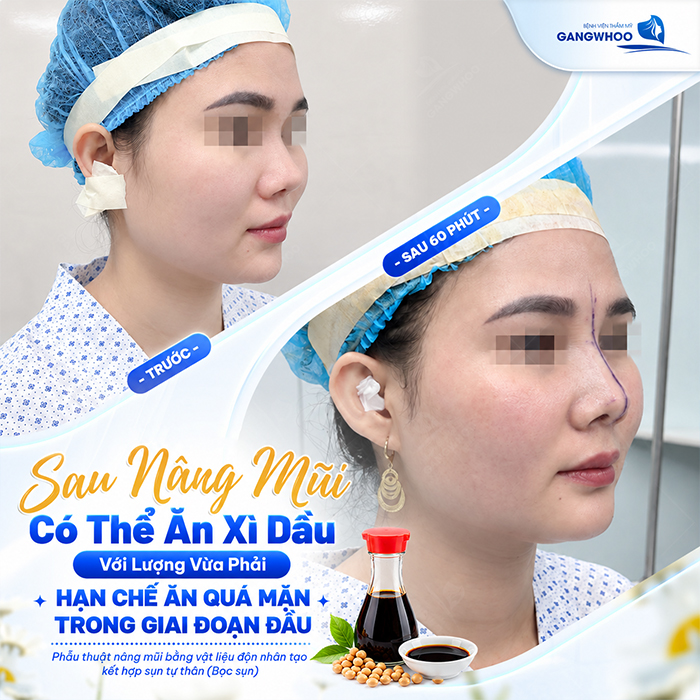 Nâng Mũi Bao Lâu Được Ăn Xì Dầu? Bác Sĩ Giải Đáp Chi Tiết