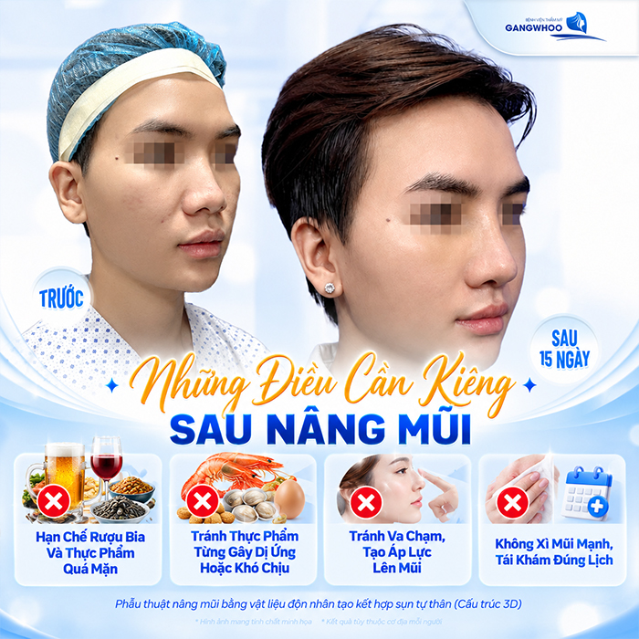 Nâng Mũi Bao Lâu Được Ăn Xì Dầu? Bác Sĩ Giải Đáp Chi Tiết
