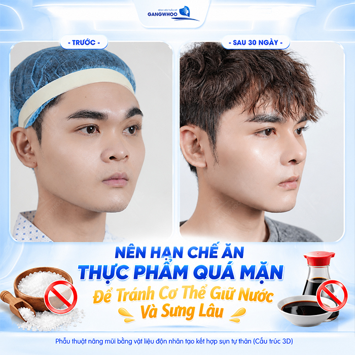 Nâng Mũi Bao Lâu Được Ăn Xì Dầu? Bác Sĩ Giải Đáp Chi Tiết