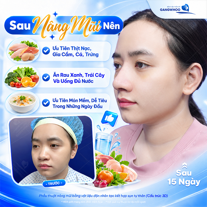 Nâng Mũi Bao Lâu Được Ăn Xì Dầu? Bác Sĩ Giải Đáp Chi Tiết