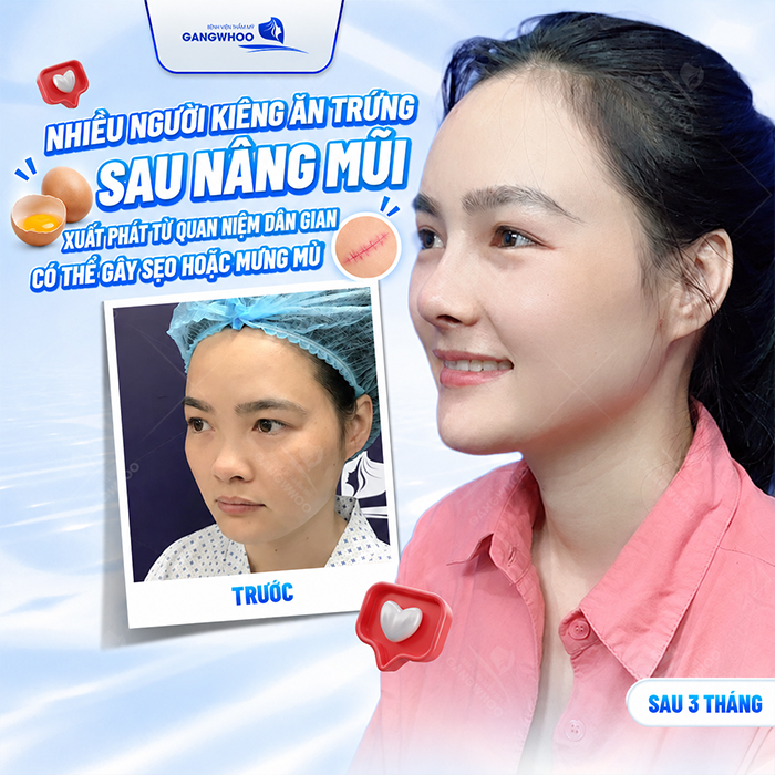 Nâng Mũi Bao Lâu Được Ăn Trứng Gà? Khi Nào Ăn Lại An Toàn?