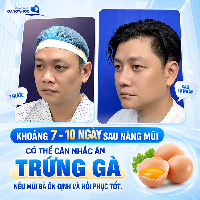 Nâng Mũi Bao Lâu Được Ăn Trứng Gà? Khi Nào Ăn Lại An Toàn?