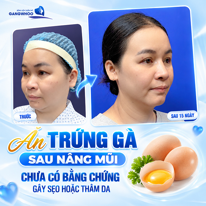Nâng Mũi Bao Lâu Được Ăn Trứng Gà? Khi Nào Ăn Lại An Toàn?