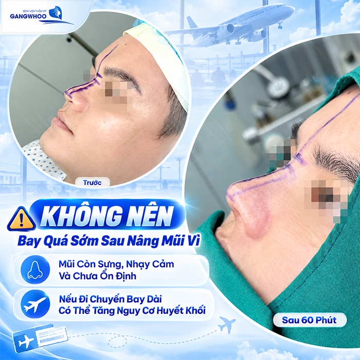 Nâng Mũi Bao Lâu Thì Đi Máy Bay Được? Bác Sĩ Giải Đáp