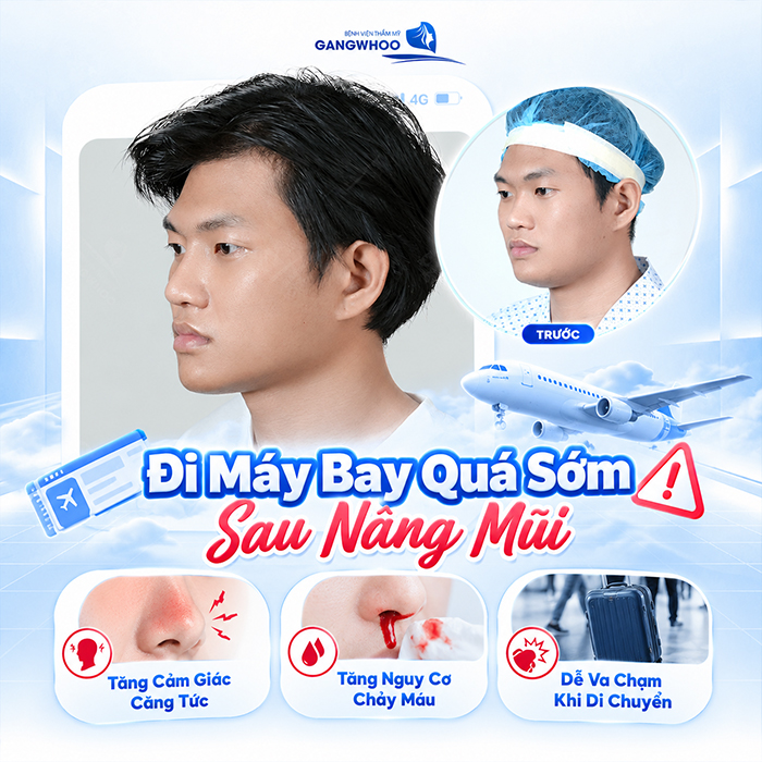 Nâng Mũi Bao Lâu Thì Đi Máy Bay Được? Bác Sĩ Giải Đáp