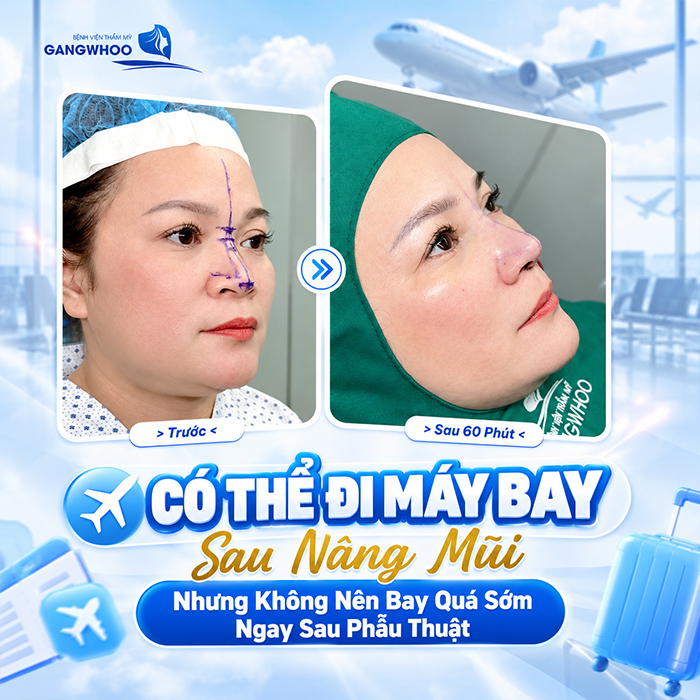 Nâng Mũi Bao Lâu Thì Đi Máy Bay Được? Bác Sĩ Giải Đáp