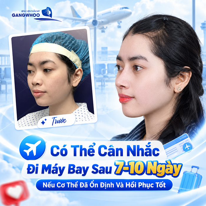 Nâng Mũi Bao Lâu Thì Đi Máy Bay Được? Bác Sĩ Giải Đáp