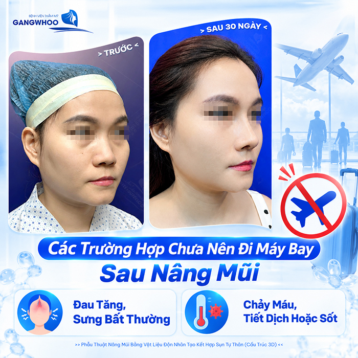 Nâng Mũi Bao Lâu Thì Đi Máy Bay Được? Bác Sĩ Giải Đáp