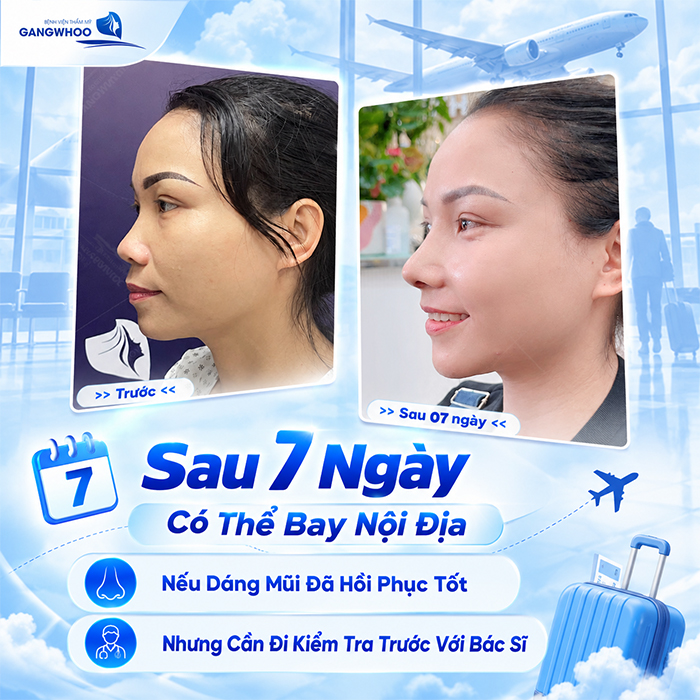 Nâng Mũi Bao Lâu Thì Đi Máy Bay Được? Bác Sĩ Giải Đáp