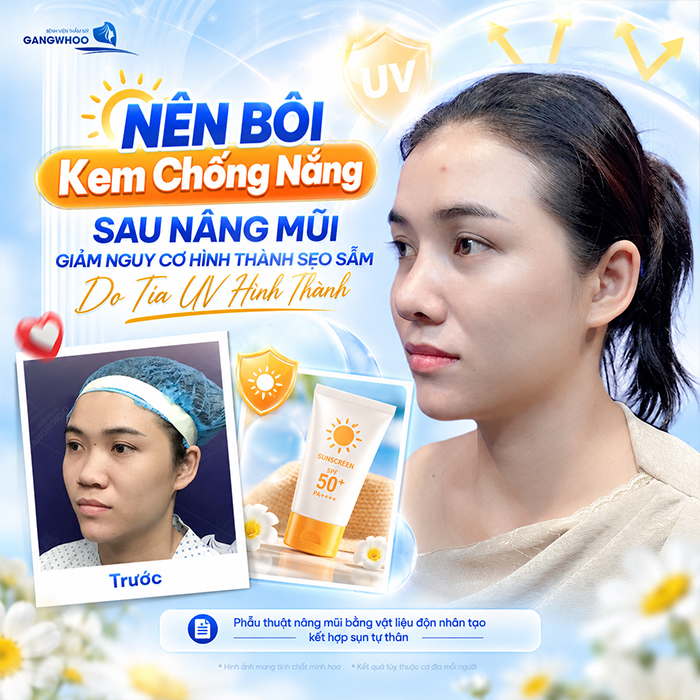 Nâng Mũi Bao Lâu Được Bôi Kem Chống Nắng? Bác Sĩ Giải Đáp