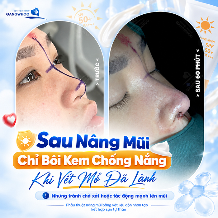 Nâng Mũi Bao Lâu Được Bôi Kem Chống Nắng? Bác Sĩ Giải Đáp